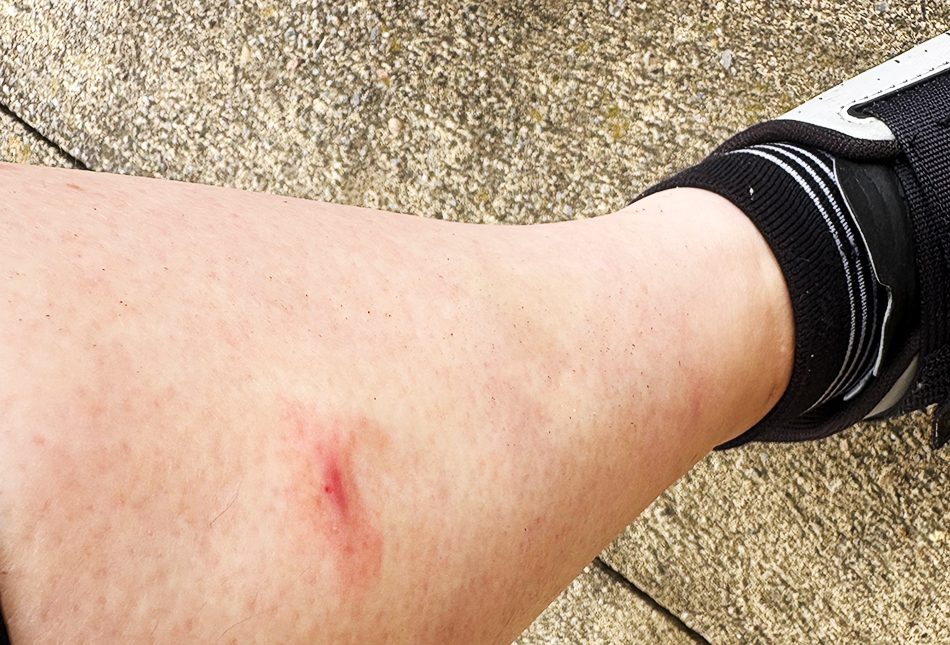 ブヨ,ブユ,刺された